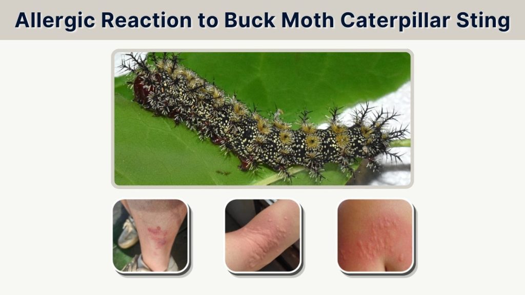 Allergic Reaction to Buck Moth Caterpillar Sting