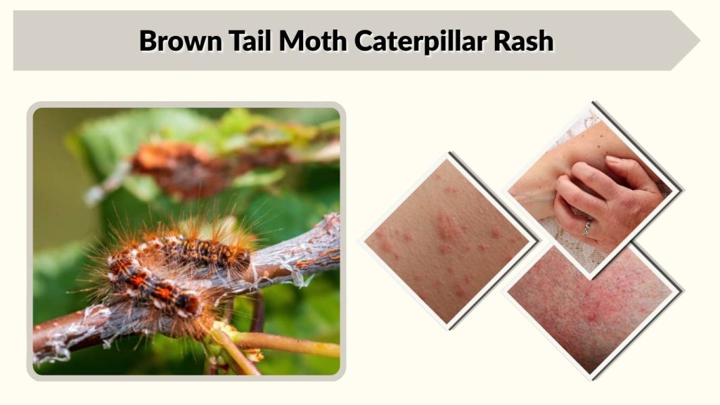 Brown Tail Moth Caterpillar Rash